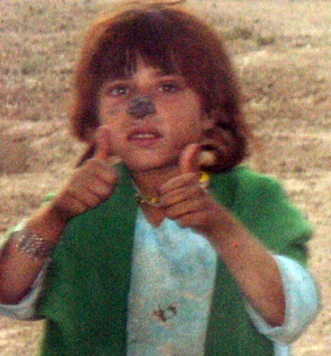 Girl With Leishmaniases